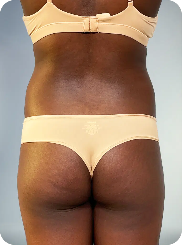 before lipo shaping services