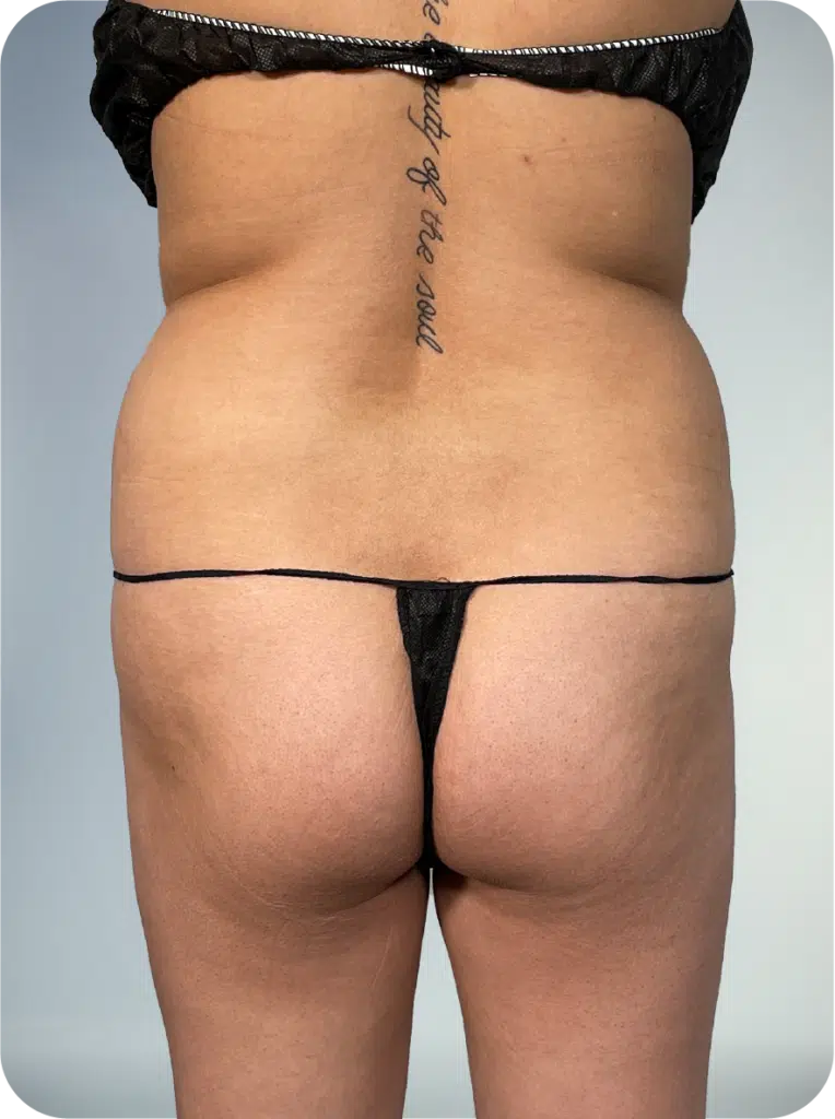 before lipo suction services