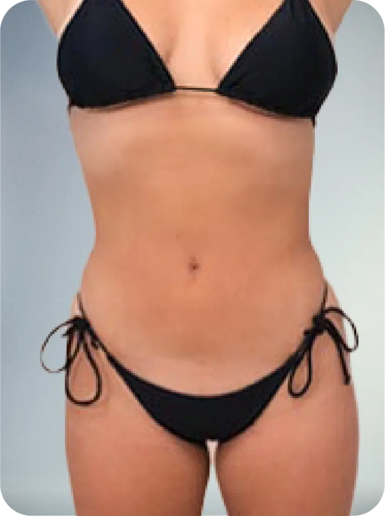 awake lipo suction services for midsection