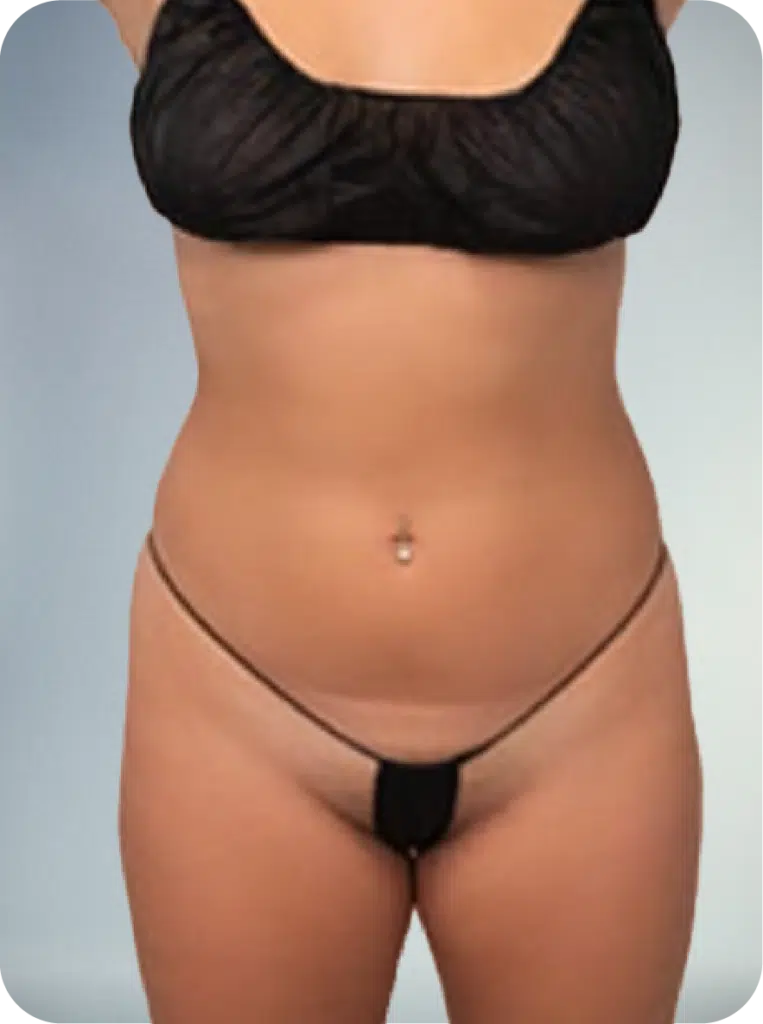 awake lipo suction services for midsection