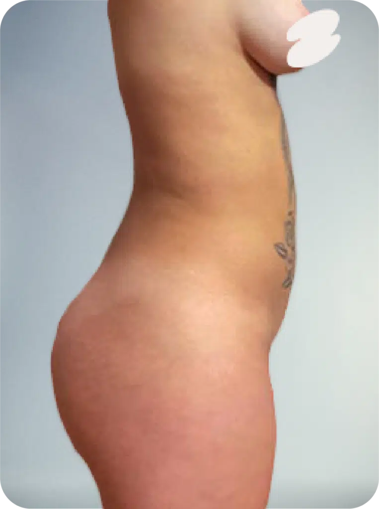 stomach lipo shaping services