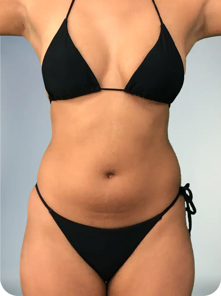 midsection lipo shaping services