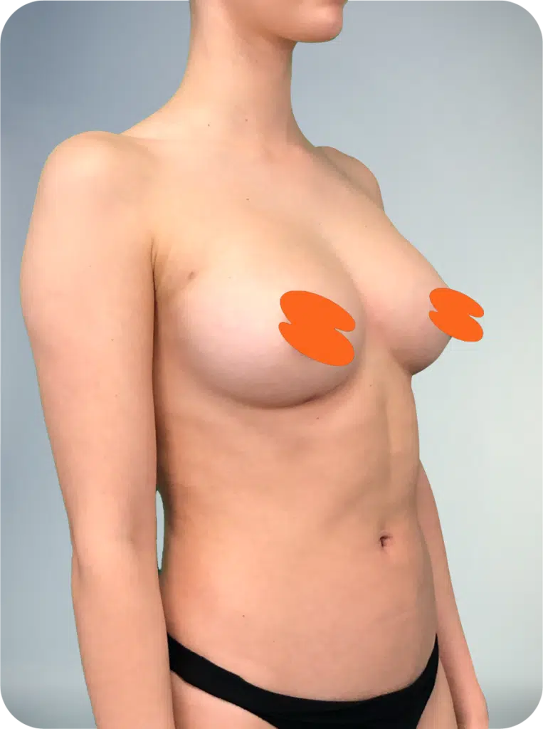 breasts lipo shaping services