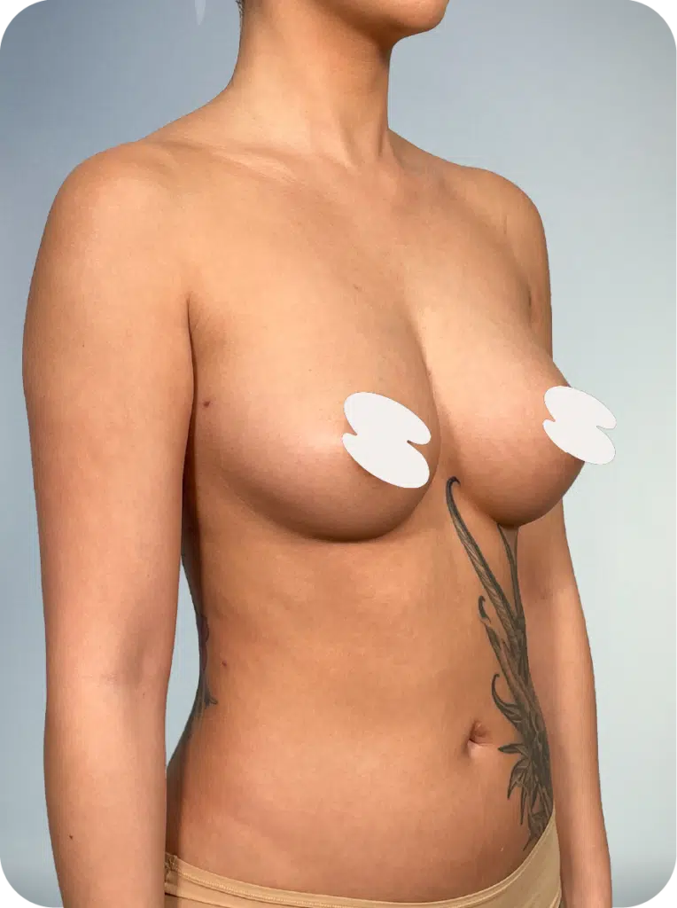 servicios de liposucción mamaria en vigilia