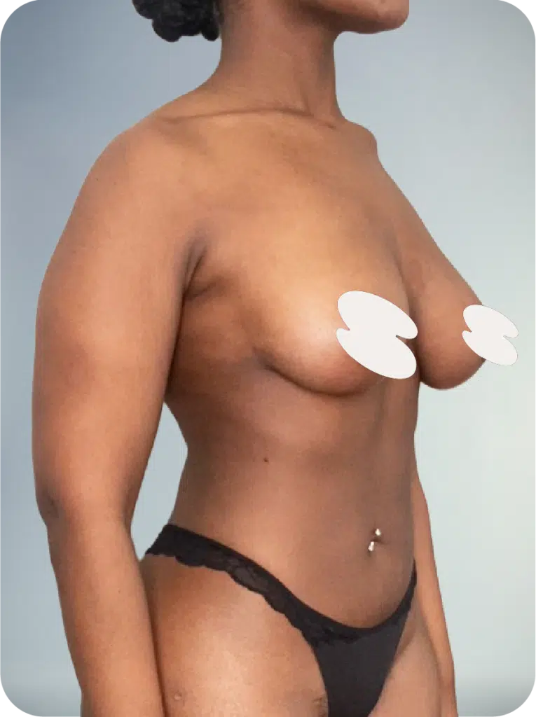naturals awake lipo shaping services for breasts