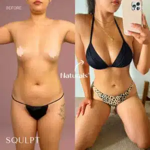 breasts lipo suction services while awake