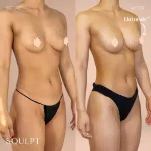 awake lipo shaping services for breasts