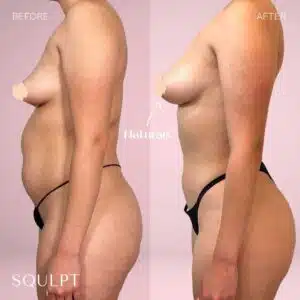 awake lipo shaping services for breasts
