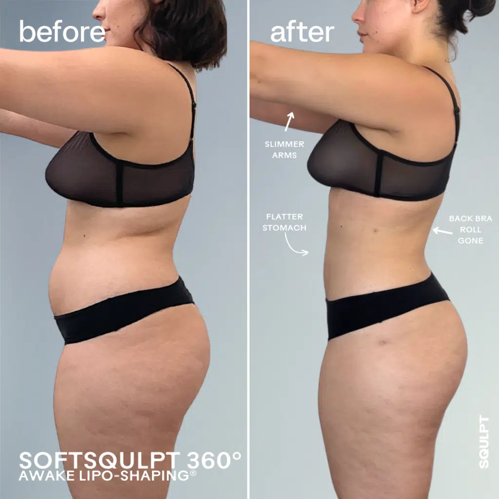 360 lipo