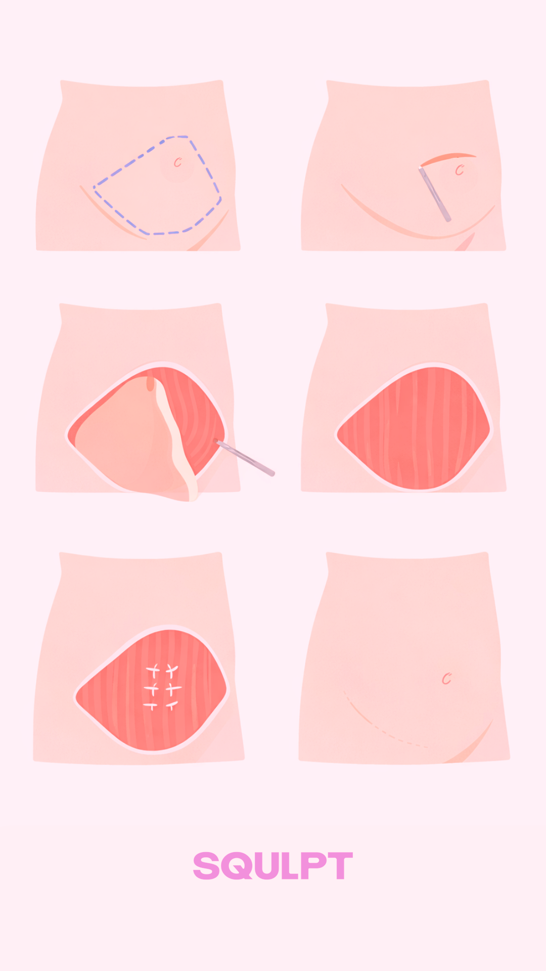 tummy tuck